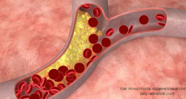 Как естественным путем почистить кровеносные сосуды и артерии