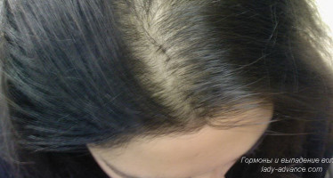 Гормоны и выпадение волос