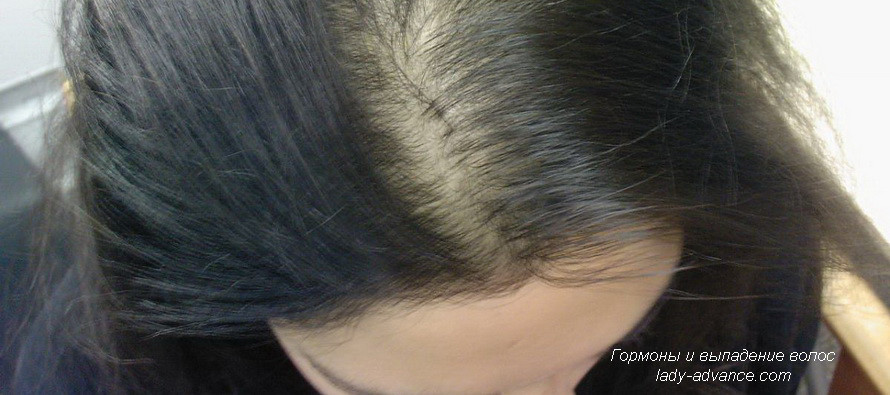 Гормоны и выпадение волос